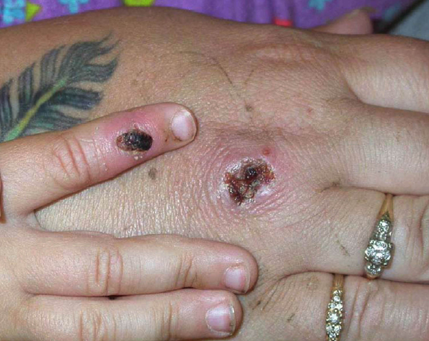 In this Centers for Disease Control and Prevention handout graphic, symptoms of one of the first known cases of the monkeypox virus are shown on a patient's hand on June 5, 2003.